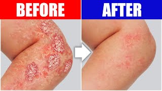 Psoriasis Relief The Best Remedy For Your Skin [upl. by Hickie]