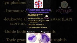 Leukemoid reaction  leukemia  Pathology neetpg pathology pathlink [upl. by Nylrebmik962]