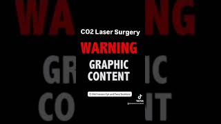 Learn why the CO2 laser is one of my favorite tools for perfroming upper and lower blepharoplasty [upl. by Walling299]