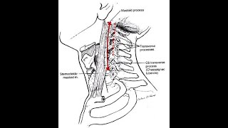 Tubercle of chassaignac or the Carotid tubercle of the 6th cervical vertebrae and its clinical relev [upl. by Mcclelland]