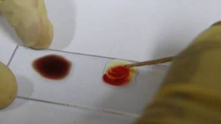 Blood Grouping Experiment  Amrita University [upl. by Aniled426]