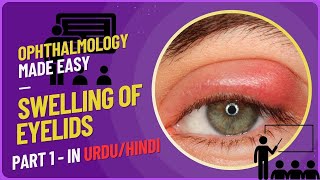 Understanding Eyelid Swellings A Comprehensive Guide to Hordeolum Chalazion Stye and Blepharitis [upl. by Eneirda988]