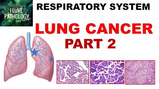 LUNG CANCER  Part 2 Morphology Clinical features [upl. by Nohsar]