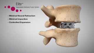 Elite™ Expandable Interbody Fusion System Animation [upl. by Nirtak925]