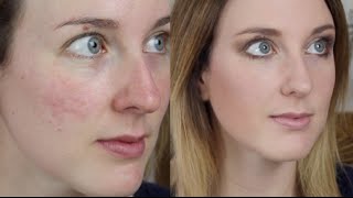 Acne Scarring Redness Foundation Routine amp Needling Experience [upl. by Goodson]