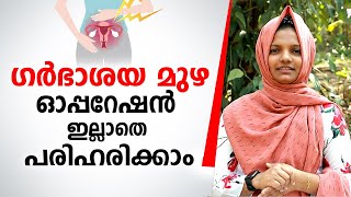 ഗർഭാശയ മുഴ ഓപ്പറേഷൻ ഇല്ലാതെ പരിഹരിക്കാം  Fibroid Treatment without Operation [upl. by Slerahc]