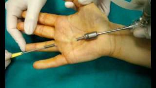 Endoscopic trigger finger [upl. by Krystalle549]