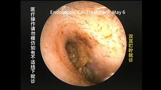 Common cerumen cleaning for narrow ear canal [upl. by Rosenblast]