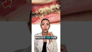 🤯 Braces can ruin your teeth Dentist Explains [upl. by Yemirej]