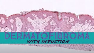 Dermatofibroma with induction phenomenon pathology dermpath dermatology dermatopathology [upl. by Ruhtra]