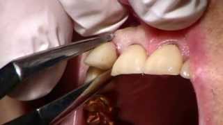 Physics Forceps Informational Video 2013  Golden Dental Solutions [upl. by Koziel]