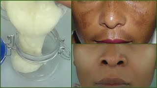 IN 7 DAYS REMOVE DARK SPOTS AND SCARS PERMANENT DARK SPOTS  SCARS REMOVER CREAM Khichi Beauty [upl. by Netsrek]