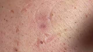 Acne Treatment Huong Da Nang  2024 blackheads 703 [upl. by Israeli343]