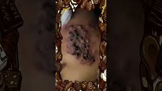 Blackheads Removal  Acne Treatment and Very Satisfying Satisfying Pimple pop blackheads [upl. by Smukler382]