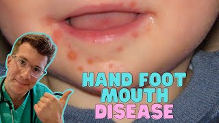 How to recognise amp treat Hand Foot and Mouth Disease Coxsackievirus in kids  Doctor ODonovan [upl. by Aksel]