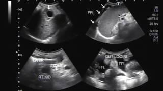 Ultrasound Video showing findings of a typical patient suffering from Hepatic Parenchymal disease [upl. by Arluene907]