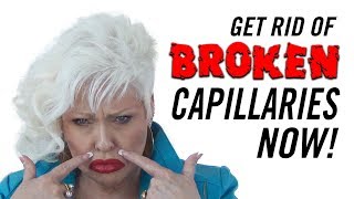 How to Get Rid of Broken Capillaries on Your Face [upl. by Matronna530]