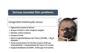 Congenital Melanocytic Nevus  Spot Diagnosis 27  Pediatrics [upl. by Carce]