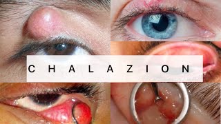 Chalazion  Ophthalmology  EASY MBBS [upl. by Tdnarb]