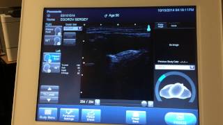 Carotid Ultrasound  Artery Wall Thickness Test and RealTime Arterial Plaque Imaging [upl. by Laekcim]