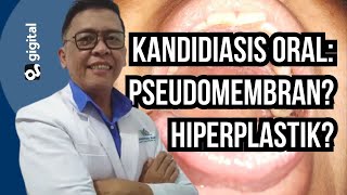 Kandidiasis oral pseudomembran ato hiperplastik  Oral candidiasis pseudomembrane or hyperplastic [upl. by Ecnarf]