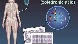 Zoledronate in Osteopenia [upl. by Maurili]