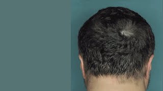 Drug Restores Hair Growth in Patients with Alopecia Areata [upl. by Rolan]