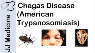 Chagas Disease  American Trypanosomiasis  Causes Symptoms and Treatment [upl. by Lurleen]