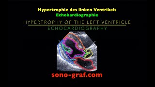 Echokardiographie  Hypertrophie des linken Ventrikels [upl. by Aguayo150]