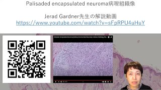 palisaded encapsulated neuroma解説動画 [upl. by Katee]