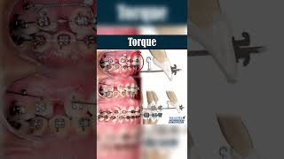 TORQUE  ORTHODONTIC TIPS Shorts [upl. by Anirbaz]