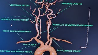 BRAIN AND NECK ANGIOGRAPHY On Ct scanALL ABOUT ANGIOGRAPHYPART1CONCEPT ON ANGIOGRAPHY [upl. by Ginnie369]