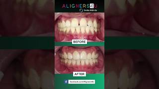 quotBefore amp After Transformationquot  Best Clear Aligners In Hyderabad  Invisible  Braces  Smile [upl. by Gnohp]