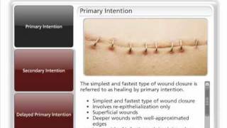 Types of Wound Closure [upl. by Esaele]