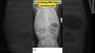 Xray showing RDS features in preterm baby RDS respiratorydistress surfactant [upl. by Becker]