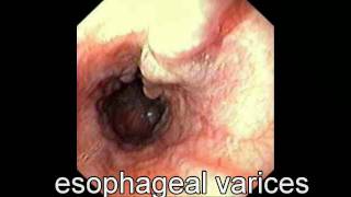 GI Bleeding An Overview  Los Angeles Colonoscopy [upl. by Yenial]