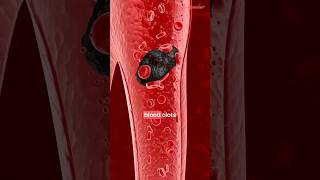 Atrial Fibrillation Explained  ECG  Afib Treatment  Management [upl. by Cas]