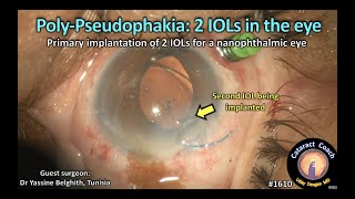 CataractCoach 1610 poly pseudophakia 2 IOLs in the eye [upl. by Ezar]