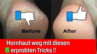 5 erprobte Tricks um extreme Hornhaut zu entfernen [upl. by Nniroc551]