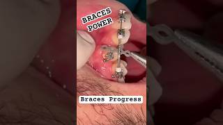 BRACES Elastic Forces  Orthodontics power [upl. by Nnyllatsyrc525]