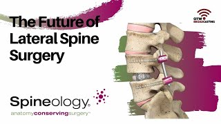 Spineology  The Future of Lateral Spine Surgery [upl. by Cyler]