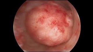 Hysteroscopic Morcellation for Removal of Fibroids [upl. by Leventis]