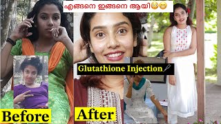 😎5 Years Fairness Cream 🧴Glutathione Injection 🩼എന്റെ മാറ്റത്തിന്റെ കാരണം😳 glamyganga [upl. by Quintilla802]