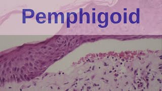 Bullous Pemphigoid  Pathology mini tutorials [upl. by Ennairej]