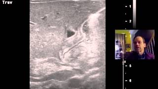 Pyloric Stenosis Ultrasound DISCUSSION 1 [upl. by Aciamaj]