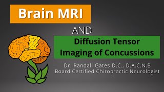 Brain MRI and Diffusion Tensor Imaging of Concussions [upl. by Hicks]