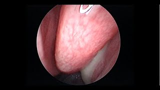 Acute Sinusitis with Postnasal Drip [upl. by Stagg]