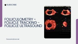 Folliculometry  Follicle Tracking  Follicle Ultrasound [upl. by Kcirtemed]