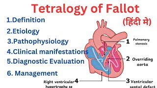 Tetralogy Of Fallot Pediatric Explanation in Hindi  Ishwar didel [upl. by Gati]