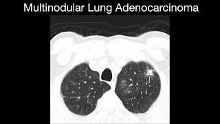 Multinodular Lung Adenocarcinoma [upl. by Plossl]